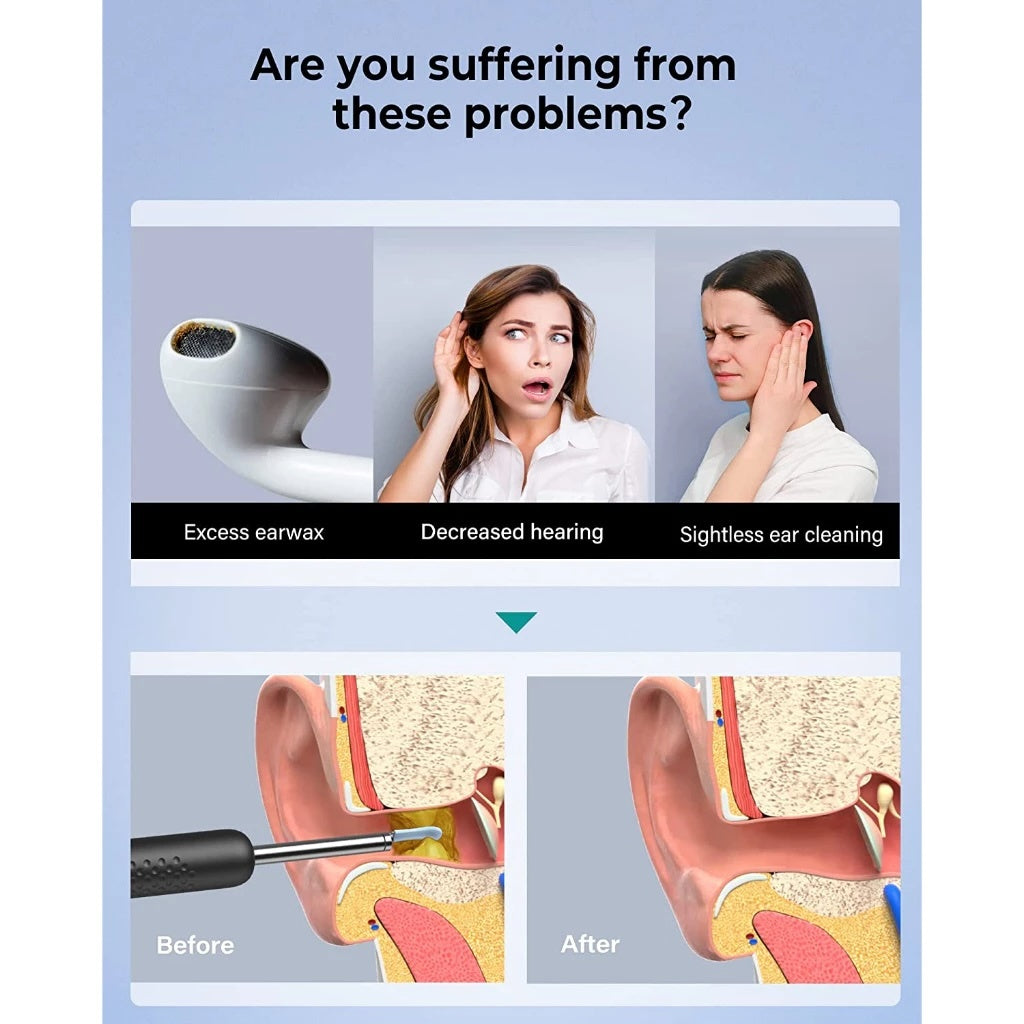 BeBird R1+ Ear Wax Removal Cleaner Otoscope Camera 6 LED Lights 1080P FHD Video